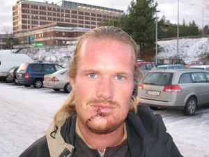 P hemkomstdagen kte jag direkt till sjukhuset i Gvle. Hakan r fortfarande lite svullen.